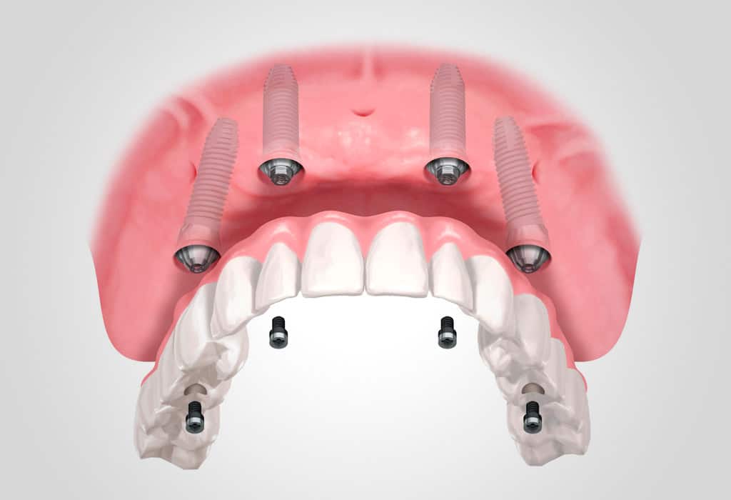 implantes dentales en Valencia