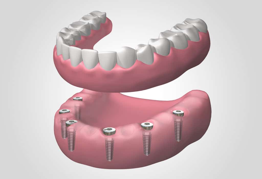implantes dentales en Valencia