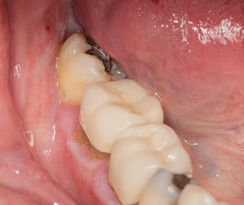 Caries dentales