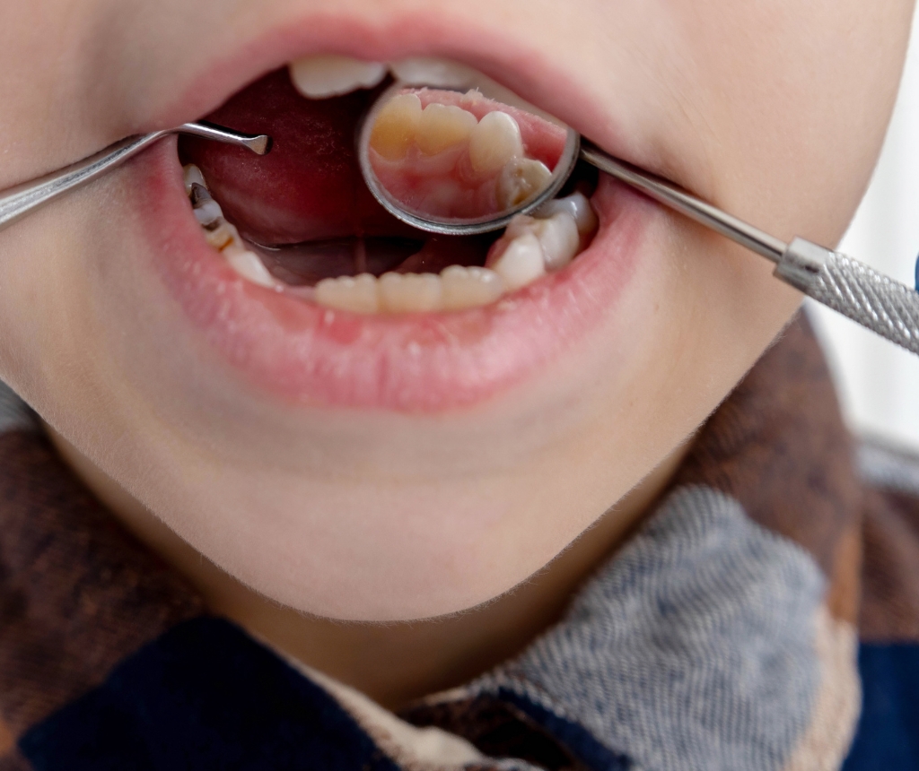 Caries infantiles