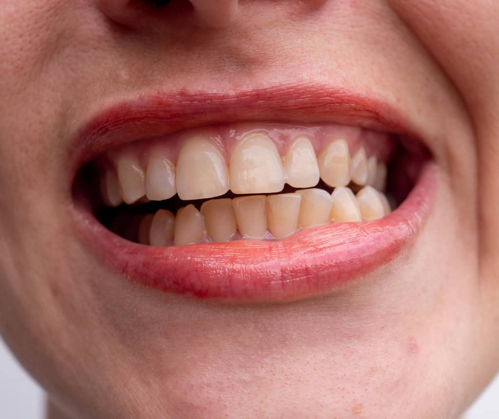 Persona apretando los dientes por bruxismo