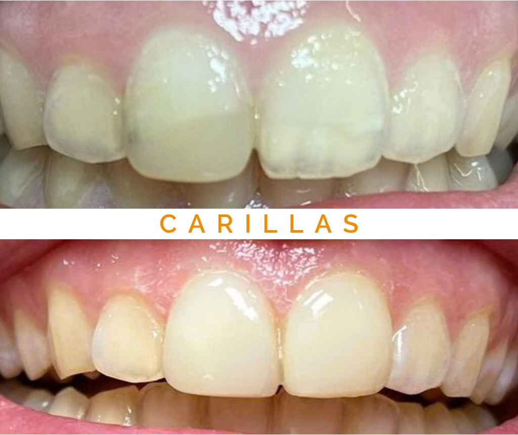 Carillas dentales en las Clínicas AlbalatDental