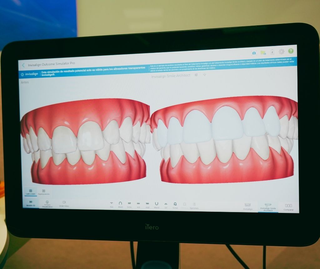 Simulación de cómo quedan las carillas dentales