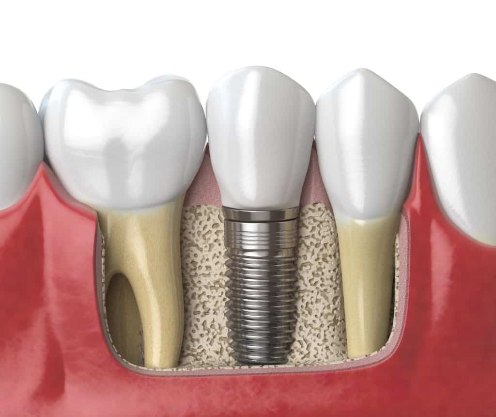 Modelo de implante dental con tornillo y corona
